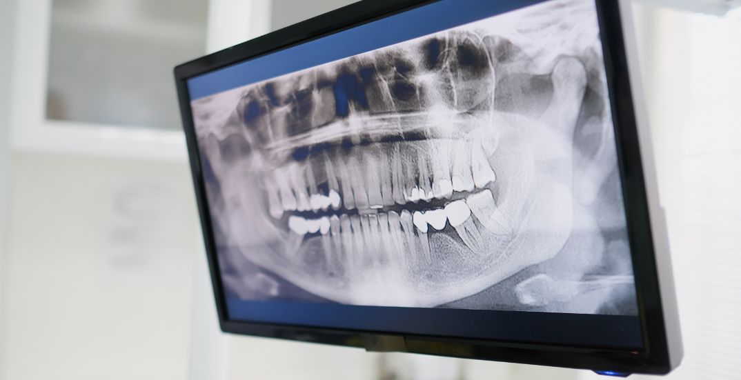 Root Canal Procedure