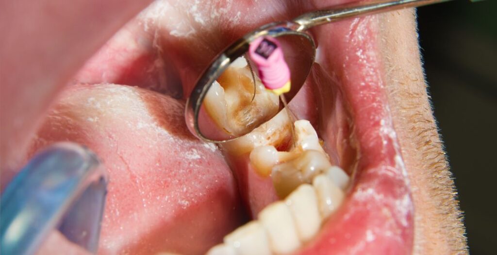 Root Canal Treatment