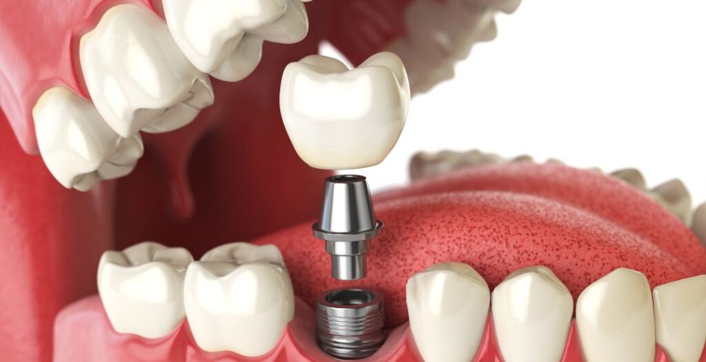 Dental Implants