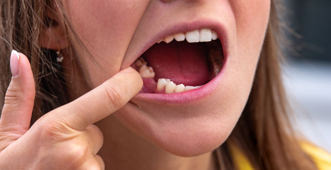 Building a Tooth-Friendly