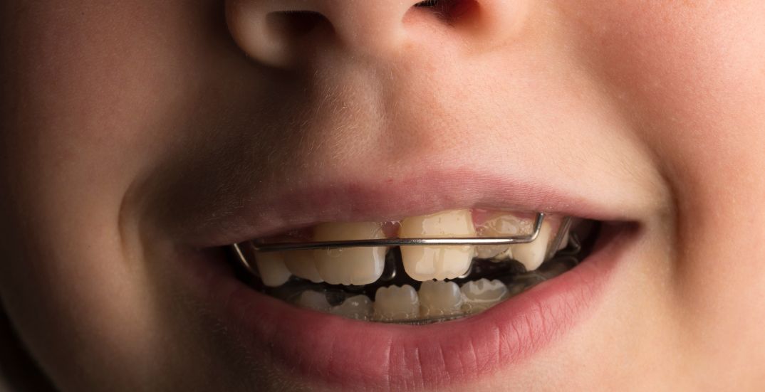 Orthodontic Issues in Children