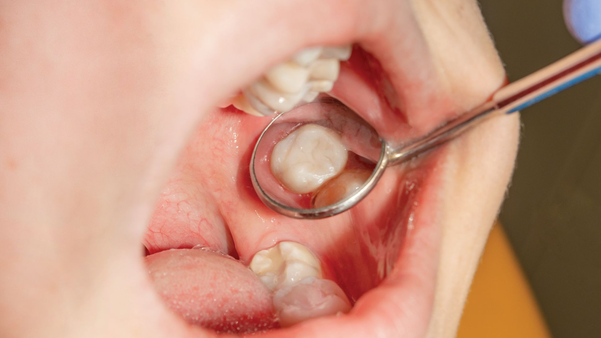 Damaged or Non-Restorable Teeth