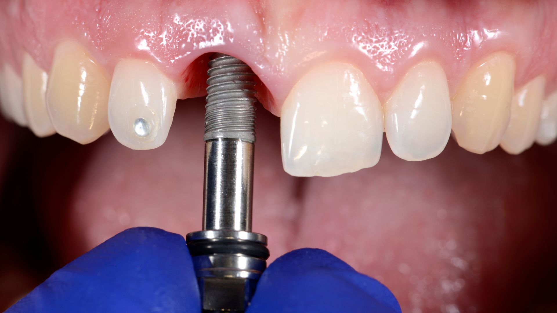 Dental Implant Process in Brief