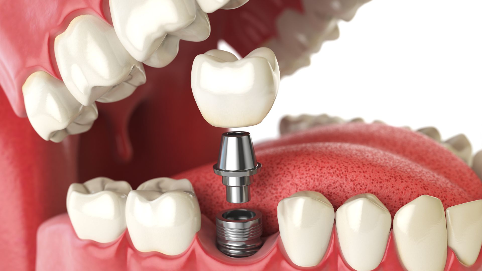 Dental Implants vs. Bridges