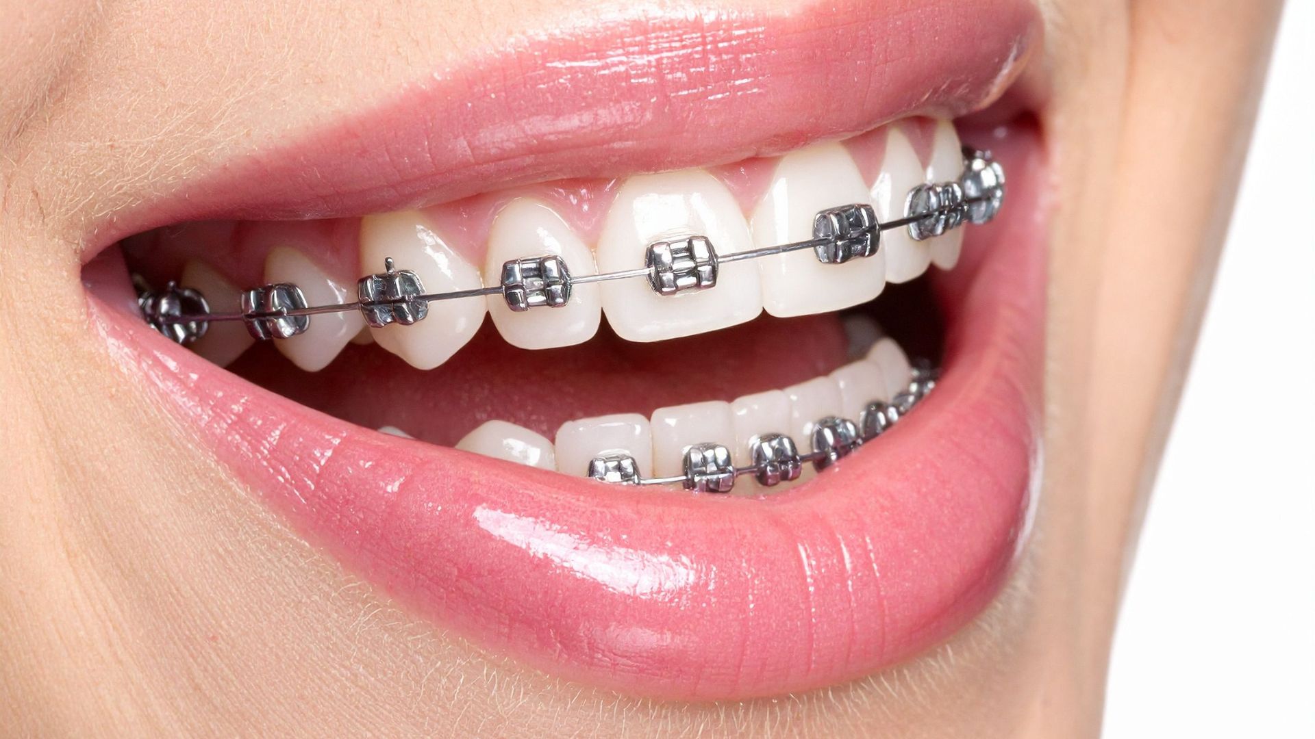 Straight Teeth, Healthy Life: Why Orthodontics Is About More Than Looks