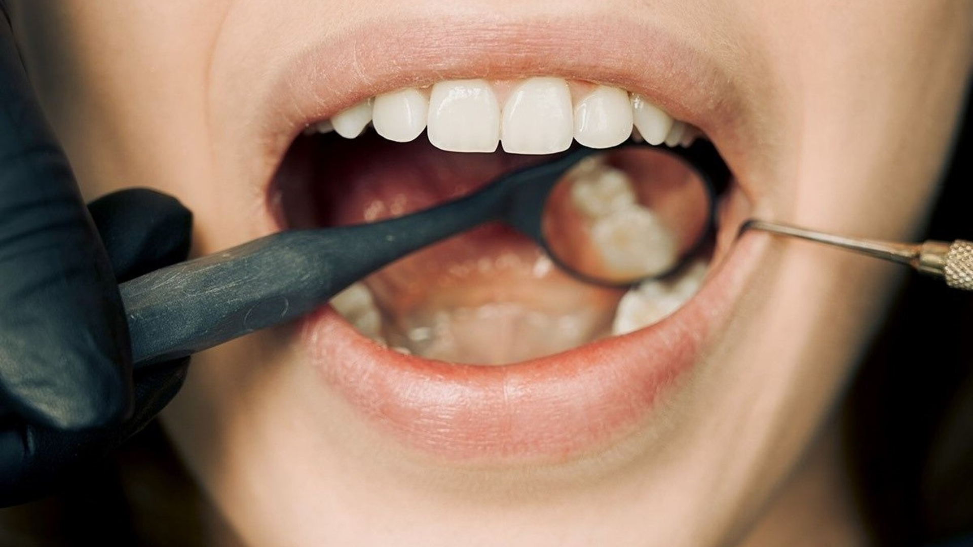 The Oral Microbiome: How Good Bacteria in Your Mouth Keep You Healthy